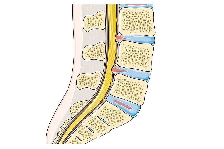 Skuteczne ćwiczenia na chromanie przestankowe, które przynoszą ulgę